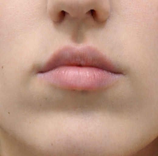 Before/After Image